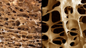 Osteoporosis damages the bone so it becomes less dense, weak and brittle