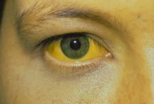 Jaundice is the yellowing of the skin and the eyes