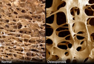 normaler Knochen im Gegensatz zu Osteoporose